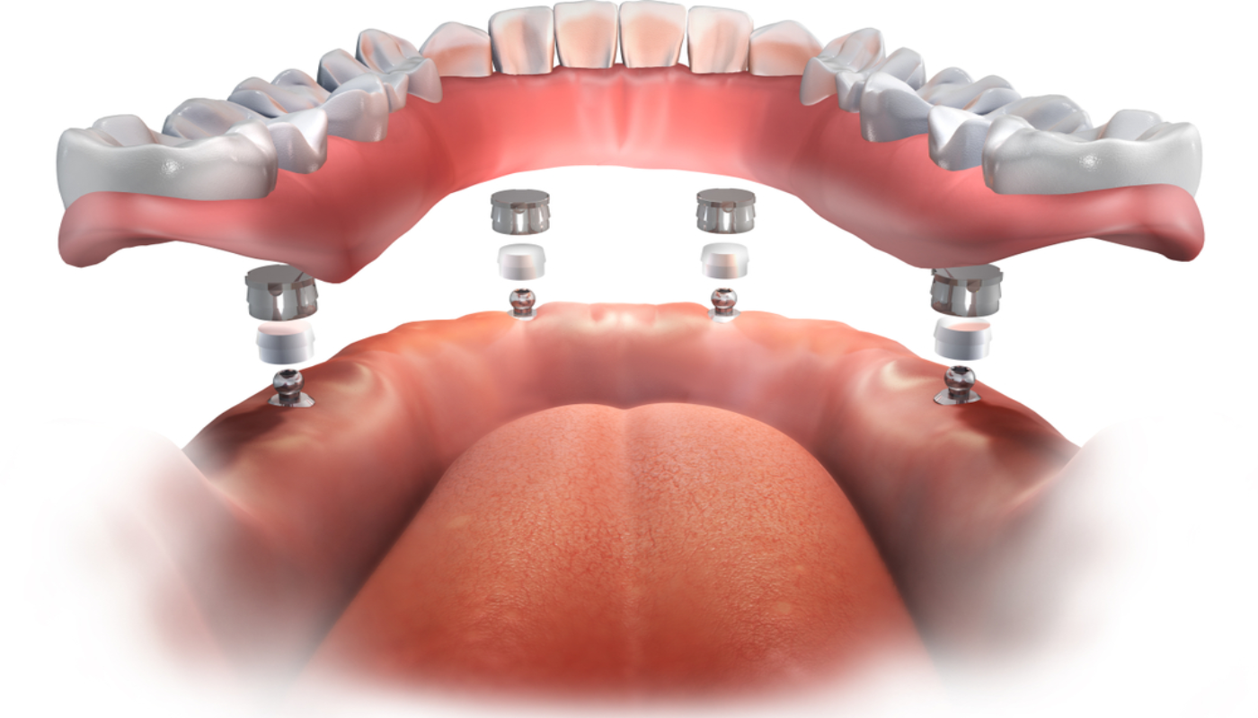 3D illustration showing All-on-4 dental implants system with four implants supporting a full arch of teeth in a human jaw. Visual representation of fixed full mouth restoration.