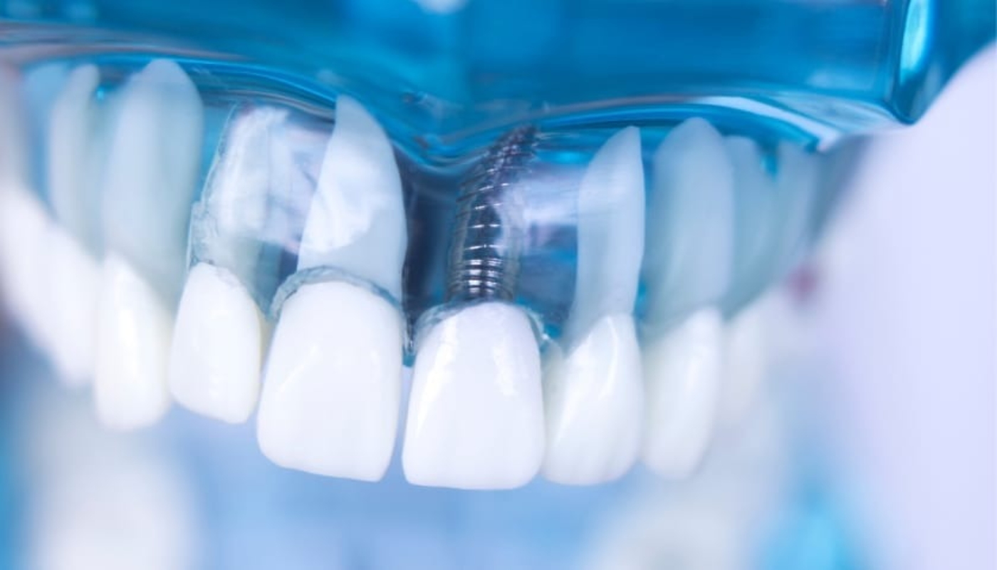Post-Operative Instructions for Dental Implants