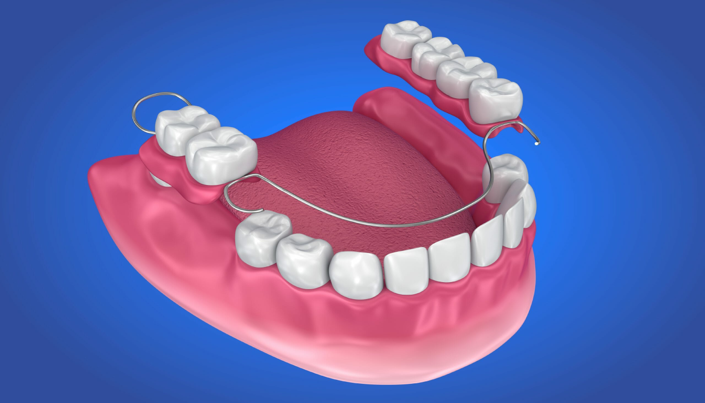 A 3D model showing how a partial removable denture with metal clasps fits on the lower jaw to replace missing teeth.