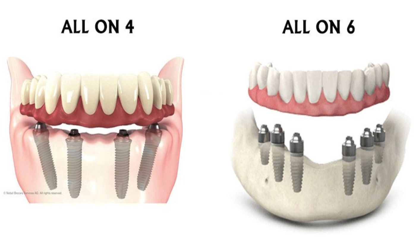 All-on-4 vs All-on-6 Dental Implants Diagram Turkey - Comparison of implant angles and placement